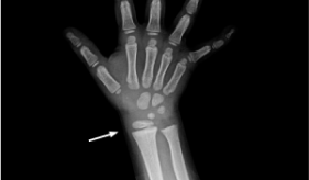X-ray image of a 4-year-old xlh patient’s right hand and wrist