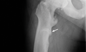 X-ray image of a 49-year-old's right subtrochanteric pseudofracture