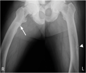 X-ray of pseudofractures in femurs