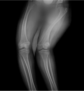 X-ray of legs indicating severe left knee lateral angulation