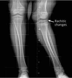 X-ray of legs indicating limb deformity