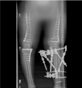 X-ray of osteotomies of femurs and left tibia