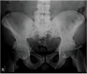 X-ray indicating disease progression in pelvis and hips