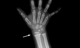 X-ray image of a 4-year-old's right hand and wrist