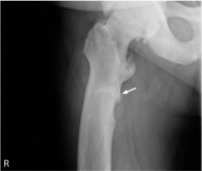 X-ray of subtrochanteric pseudofracture