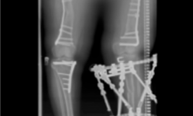 X-ray image of a 15-year-old's legs showing osteotomies of femurs and left tibia