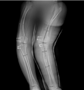 X-ray of legs indicating severe left knee lateral angulation