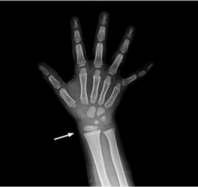 X-ray of right wrist