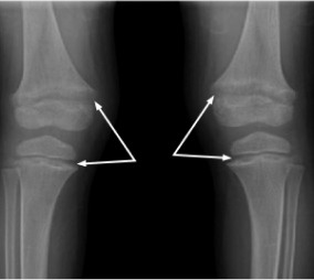 X-ray of knees