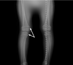 X-ray of legs