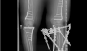 X-ray image of a 15-year-old xlh patient’s legs showing osteotomies of femurs and left tibia