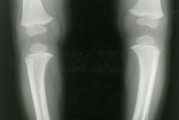 X-ray image representing bowed legs in a child with XLH