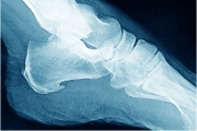 X-ray image representing enthesopathy in the foot