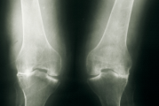 X-ray image representing knock knees in a child with XLH