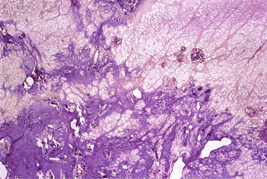 Micrograph image of osteomalacia in the bones