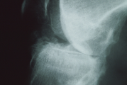 X-ray image representing rickets in a child with XLH
